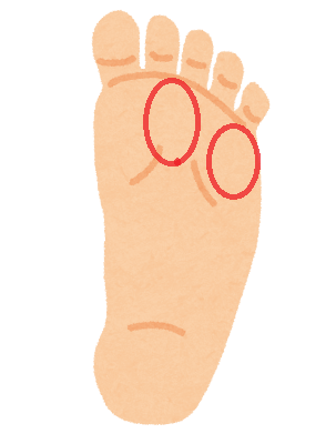 足裏のイラスト。中指の付け根下と小指の付け根下の2箇所に赤丸が付いており、皮膚が硬くなりやすい部位を示している。